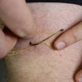 Video: How to Remove a Fish Hook from Human Skin